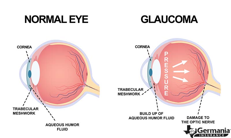 A diagram of the common eye disease glaucoma