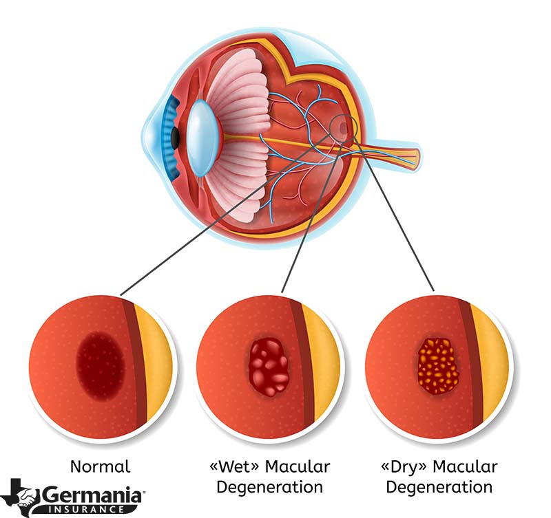 A diagram of age-related macular degeneration