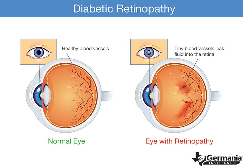 Diagram of diabet retinopathy