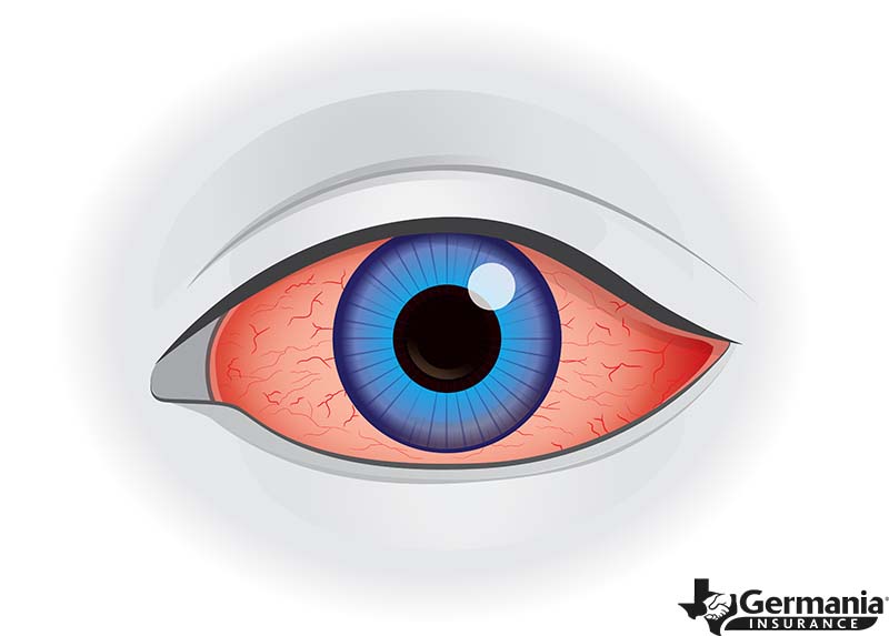 Image of dry eyes